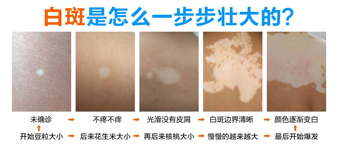 宁波治疗白癜风哪些医院好 白癜风早期症状